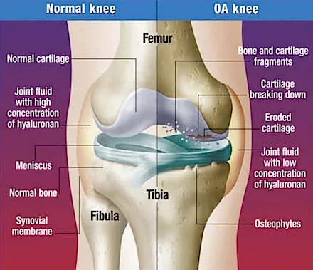 fitness-physio-osteoarthritis-joint