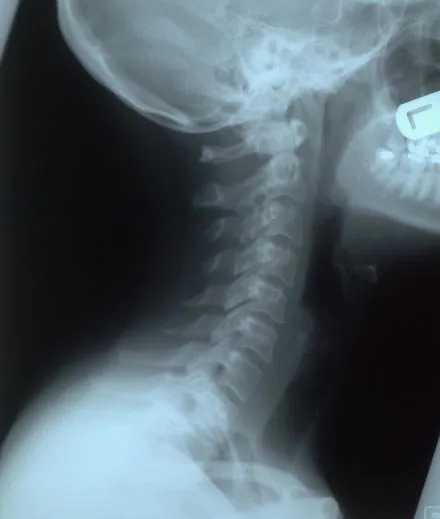 Neck-X-ray Neck-X-ray